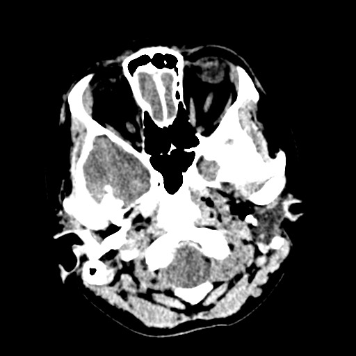 Cerebral tuberculosis with dural sinus invasion (Radiopaedia 60353-68018 Axial non-contrast 5).jpg