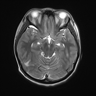 File:Cerebral tuberculosis with dural sinus invasion (Radiopaedia 60353-68090 Axial T2 9).jpg