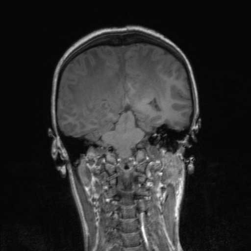 Cerebral tuberculosis with dural sinus invasion (Radiopaedia 60353-68090 Coronal T1 120).jpg