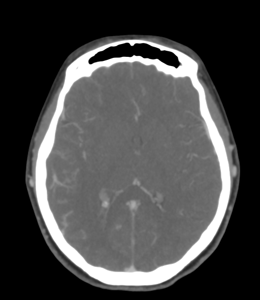 File:Cerebral venous hemorrhagic infarction (Radiopaedia 38461-40550 Axial MIP VENOGRAM 28).png