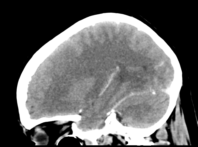 Cerebral venous hemorrhagic infarction (Radiopaedia 57576-64538 Sagittal C+ 20).png