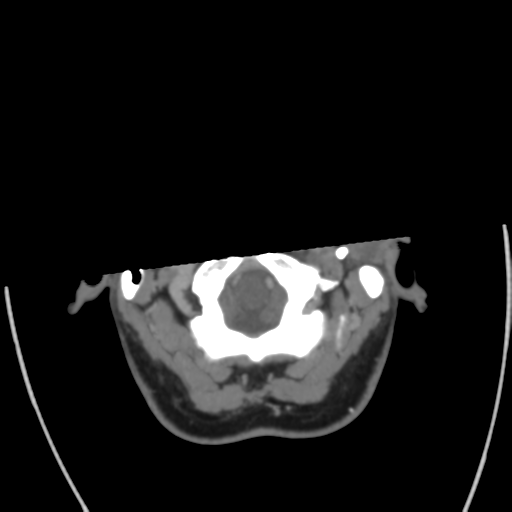 File:Cerebral venous infarct related to dural venous sinus thromboses (Radiopaedia 35292-36804 Axial C+ delayed 6).png