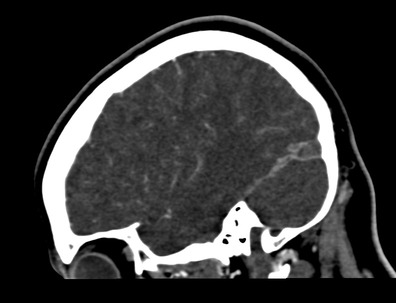Cerebral venous sinus thrombosis (Radiopaedia 59224-66646 Sagittal C+ delayed 50).jpg