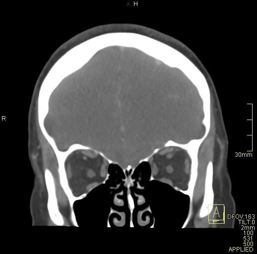 Cerebral venous sinus thrombosis (Radiopaedia 91329-108965 Coronal venogram 22).jpg