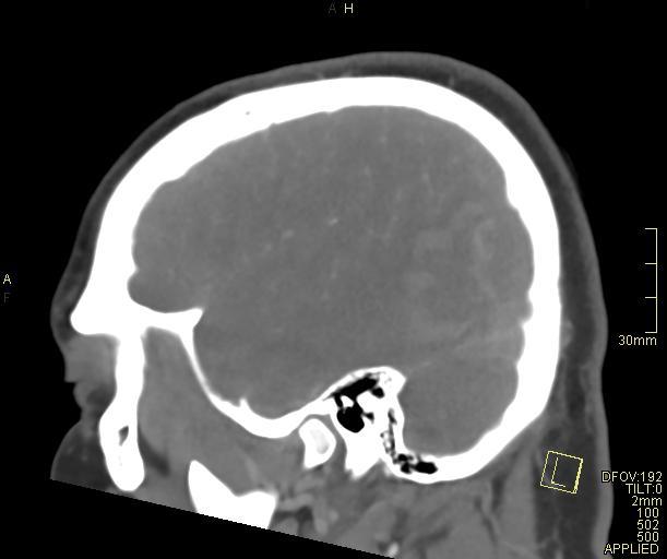 Cerebral venous sinus thrombosis (Radiopaedia 91329-108965 Sagittal venogram 61).jpg