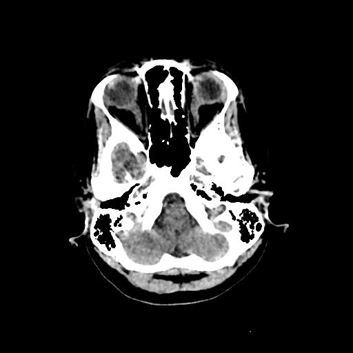 File:Cerebral venous throbmosis - hemorrhagic venous infarction (Radiopaedia 87318-103613 Axial non-contrast 28).jpg