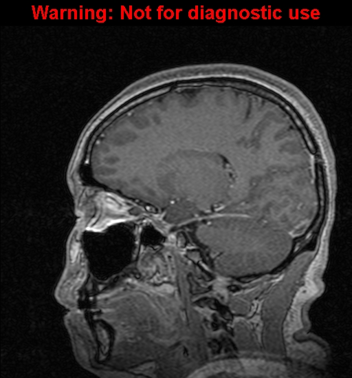 Cerebral venous thrombosis (Radiopaedia 37224-39208 Sagittal T1 C+ 93).jpg