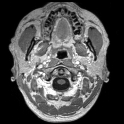 Cerebral venous thrombosis (Radiopaedia 38392-40469 Axial T1 C+ 4).png
