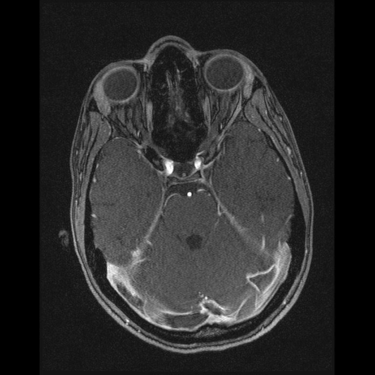 Cerebral venous thrombosis (Radiopaedia 45678-49854 Axial MRV 22).jpg