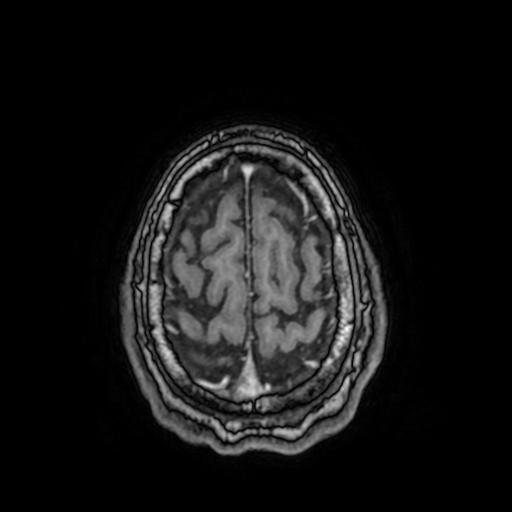 File:Cerebral venous thrombosis with secondary intracranial hypertension (Radiopaedia 89842-106957 Axial T1 C+ 148).jpg