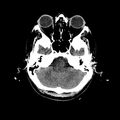 Cerebral venous thrombosis with venous hemorrhagic infarct (Radiopaedia 90354-107660 Axial non-contrast 12).jpg