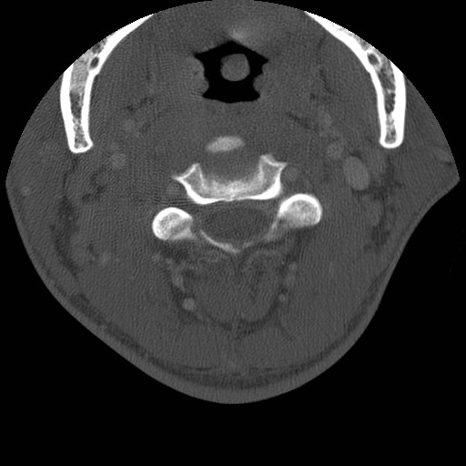 Cervical Pott disease (Radiopaedia 20374-20286 Axial bone window 48).jpg