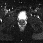 Cervical adenocarcinoma (Radiopaedia 65011-73985 Axial DWI 22).jpg
