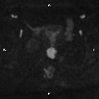 Cervical adenocarcinoma (Radiopaedia 65011-73985 Axial DWI 48).jpg