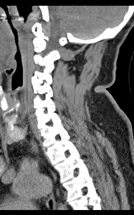 Cervical canal stenosis - OPLL and osteophytes (Radiopaedia 47329-51910 B 32).png