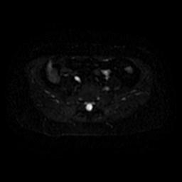 File:Cervical carcinoma (Radiopaedia 67644-77047 Axial DWI 29).jpg