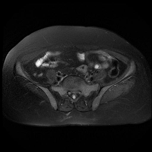 File:Cervical carcinoma (Radiopaedia 88010-104555 Axial T2 fat sat 3).jpg
