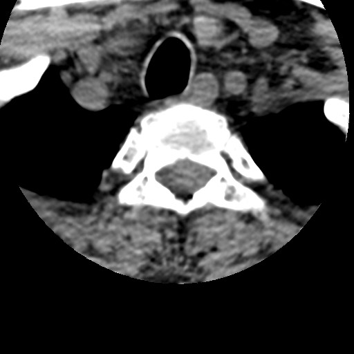 File:Cervical spinal neurofibroma in a patient with NF1 (Radiopaedia 58344-65464 Axial non-contrast 74).jpg
