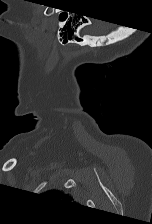 Cervical spine ACDF loosening (Radiopaedia 48998-54070 Sagittal bone window 7).png