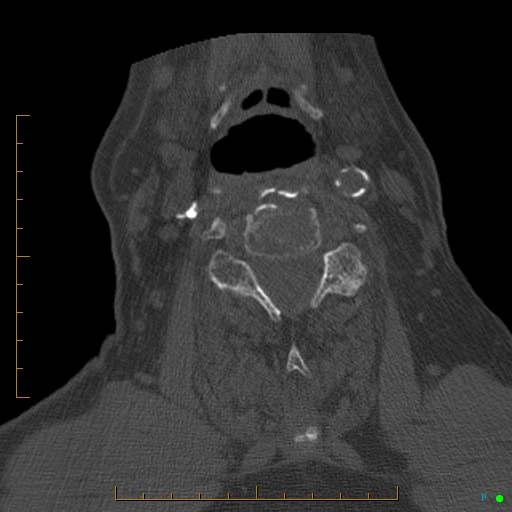 File:Cervical spine fracture - ankylosing spondylitis (Radiopaedia 76835-88706 Axial bone window 118).jpg