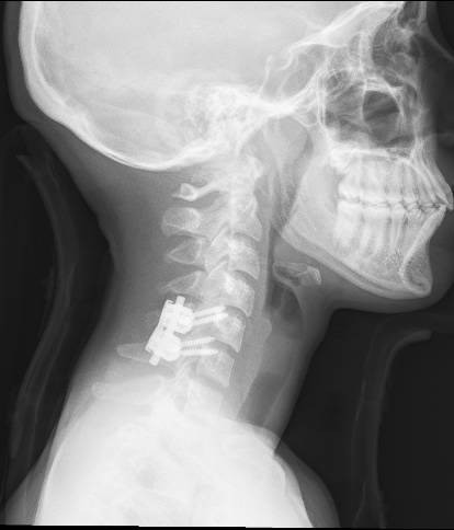 File:Cervical spine posterior ligamentous complex rupture (Radiopaedia 63486-72102 Lateral 1).jpg