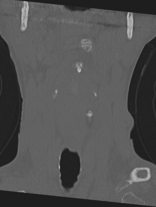 Cervical spondylolysis (Radiopaedia 49616-54811 Coronal bone window 6).png