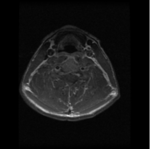 File:Cervical vertebrae metastasis (Radiopaedia 78814-91667 Axial T1 C+ 9).png
