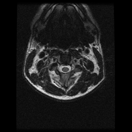 File:Cervical vertebrae metastasis (Radiopaedia 78814-91667 Axial T2 18).png