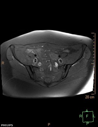 File:Cesarian scar endometriosis (Radiopaedia 68495-78066 Axial T1 fat sat 5).jpg