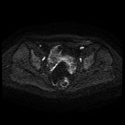 Cesarian section scar endometriosis (Radiopaedia 66520-75799 Axial DWI 64).jpg