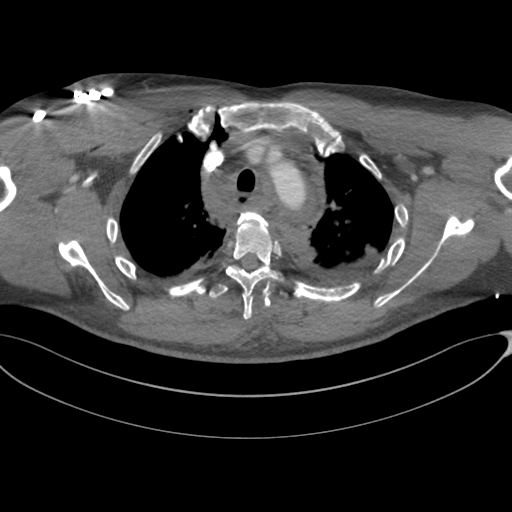 File:Chest multitrauma - aortic injury (Radiopaedia 34708-36147 A 73).png
