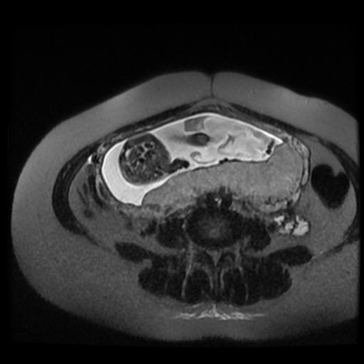 Chiari II malformation - fetal MRI (Radiopaedia 68099-77581 Axial T2-SSFSE 14).jpg