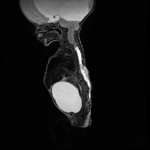 File:Chiari II malformation with spinal meningomyelocele (Radiopaedia 23550-23652 Sagittal T2 6).jpg
