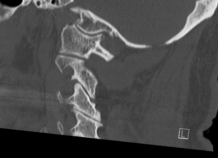 Chiari I malformation with a symptomatic syrinx of the posterolateral medulla oblongata (Radiopaedia 42573-45707 A 20).jpg