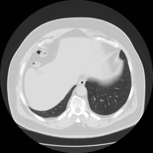File:Chilaiditi’s syndrome (Radiopaedia 27550-27756 Axial lung window 18).jpg