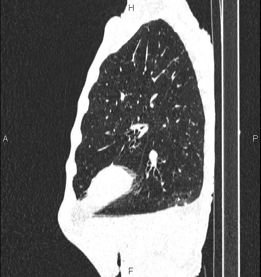 File:Chilaiditi sign (Radiopaedia 88839-105611 Sagittal lung window 73).jpg