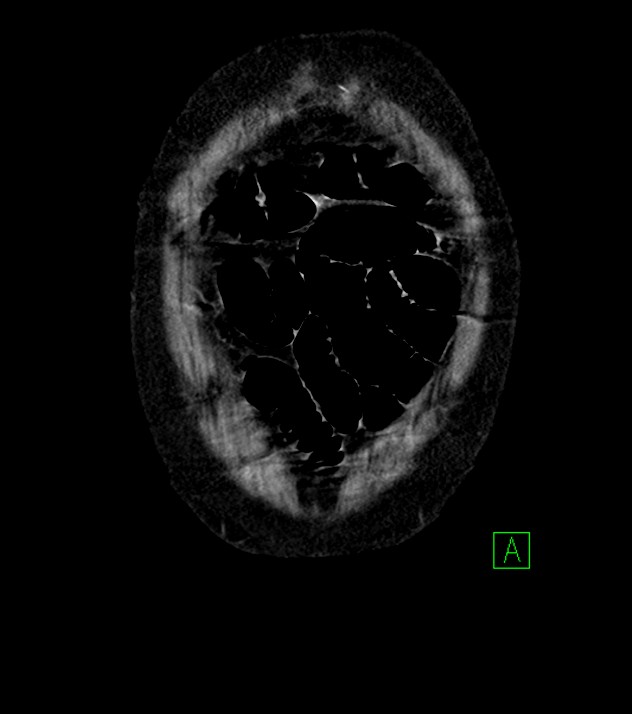 Cholangiocarcinoma with cerebral metastases (Radiopaedia 83519-98629 G 3).jpg