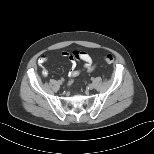 Cholecystitis with focal perforation and hepatic abscess (Radiopaedia 37189-38945 Axial non-contrast 66).png