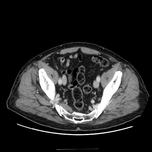 Choledocholiathiasis with normal caliber common bile duct (Radiopaedia 75368-86632 A 161).jpg