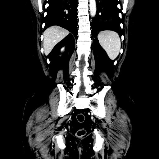 Choledocholiathiasis with normal caliber common bile duct (Radiopaedia 75368-86632 Coronal liver window 94).jpg