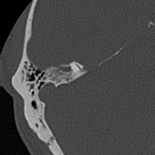 File:Cholesteatoma (Radiopaedia 15846-15494 bone window 3).jpg