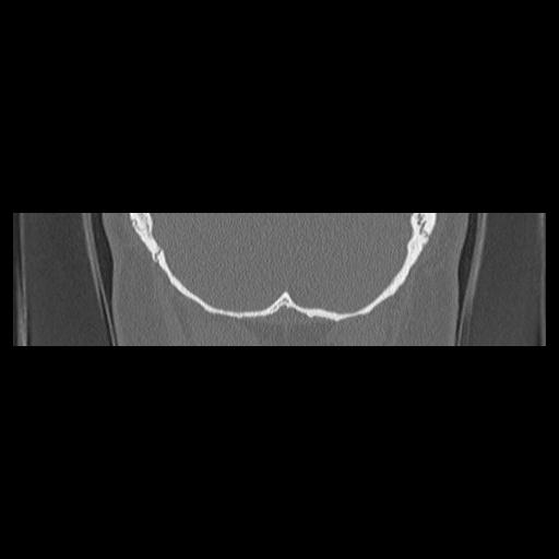 Cholesteatoma (Radiopaedia 84946-100455 Coronal bone window 144).jpg