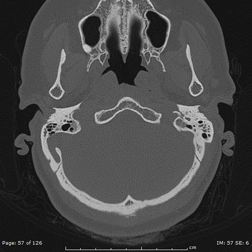 Cholesteatoma - external auditory canal (Radiopaedia 88452-105096 Axial bone window 20).jpg