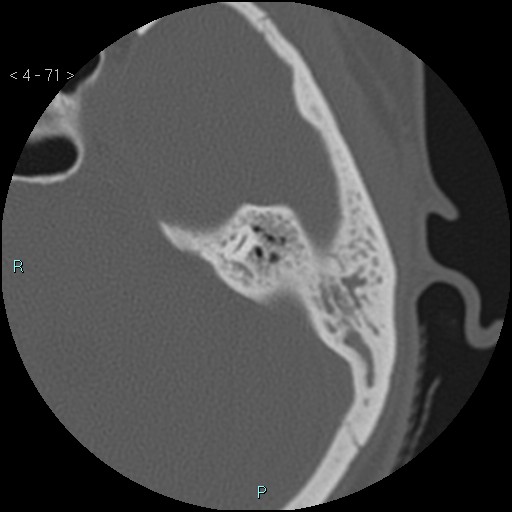 File:Cholesterol granuloma of the petrous apex (Radiopaedia 64358-73141 Axial bone window 34).jpg