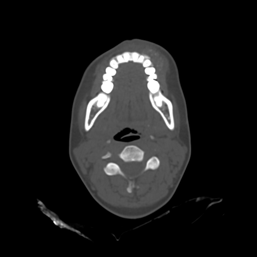 File:Chondroblastic osteosarcoma (Radiopaedia 67363-76741 Axial bone window 14).jpg