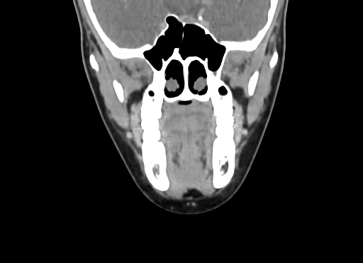 Chondroblastic osteosarcoma (Radiopaedia 67363-76741 D 45).jpg
