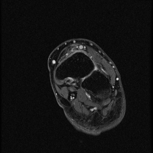 File:Chondroblastoma - midfoot (Radiopaedia 64831-73765 G 10).jpg