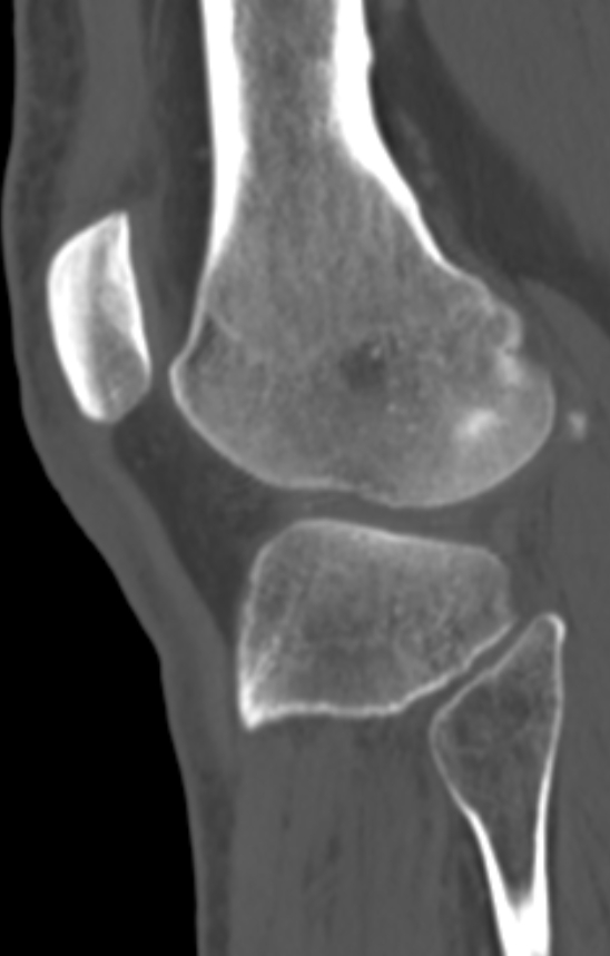 Chondrocalcinosis (Radiopaedia 82862-97173 Sagittal bone window 52).jpg