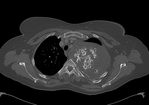 Chondrosarcoma - chest wall (Radiopaedia 65192-74199 Axial bone window 33).jpg