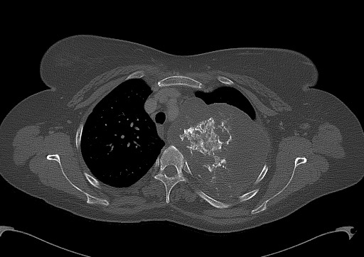 Chondrosarcoma - chest wall (Radiopaedia 65192-74199 Axial bone window 36).jpg